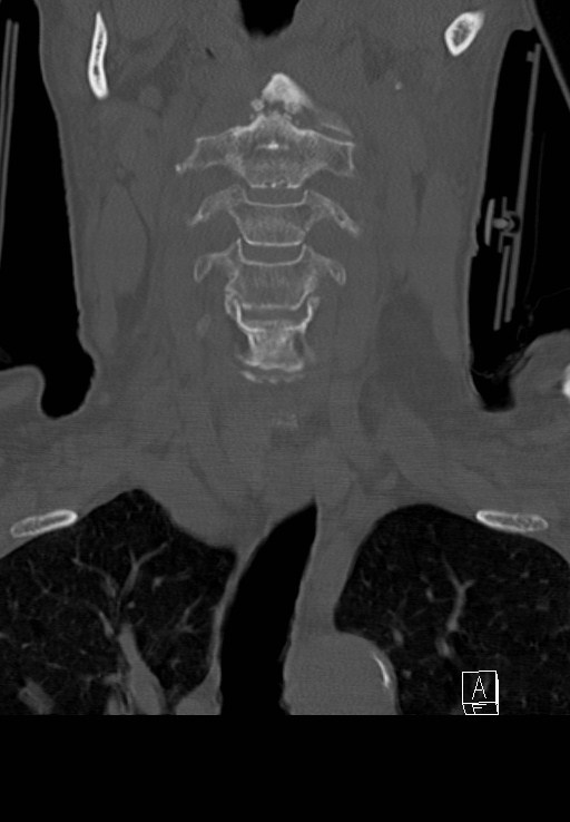 C1 and C2 (peg) fractures (Radiopaedia 36618-38184 Coronal bone window 16).jpg