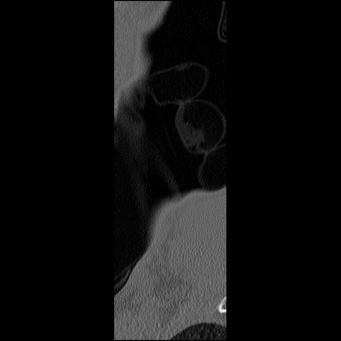 C5 facet fracture (Radiopaedia 58374-65499 Sagittal bone window 71).jpg