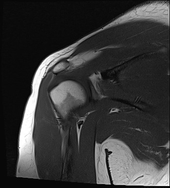 File:Calcific tendinitis of the infraspinatus tendon (Radiopaedia 87256-103537 Coronal T1 14).jpg