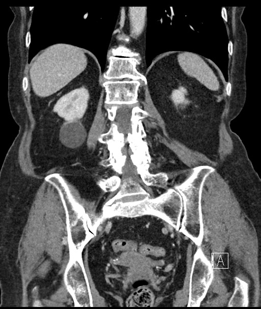 Calcified adrenal glands and Spigelian hernia (Radiopaedia 49741-54988 B 82).jpg