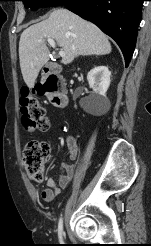 Calcified adrenal glands and Spigelian hernia (Radiopaedia 49741-54988 C 110).jpg
