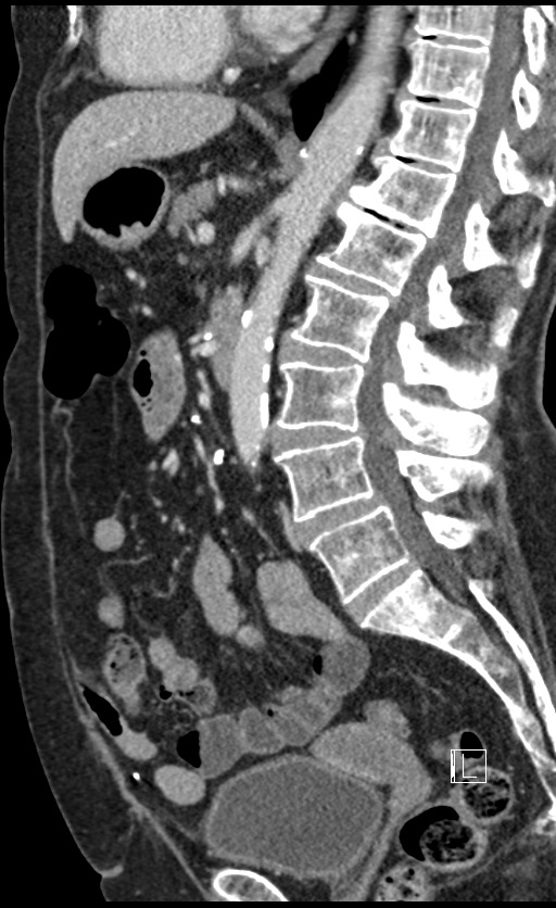 Calcified adrenal glands and Spigelian hernia (Radiopaedia 49741-54988 C 80).jpg