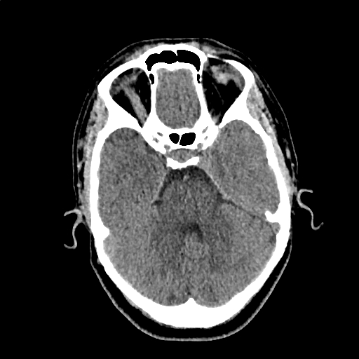 File:Calcified cerebral hydatid cyst (Radiopaedia 65603-74717 Axial non-contrast 17).jpg
