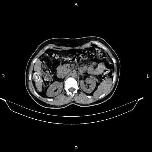 File:Calcified hepatic hydatid cyst (Radiopaedia 84672-100095 Axial non-contrast 37).jpg