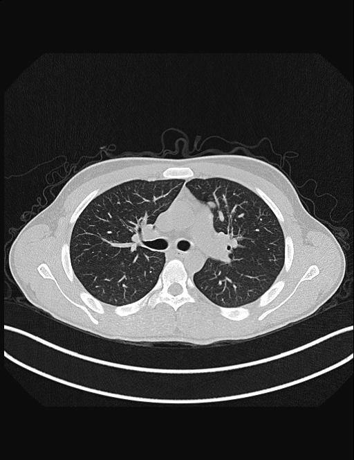 Calcifying pulmonary metastases (Radiopaedia 33359-34396 Axial lung window 24).jpg