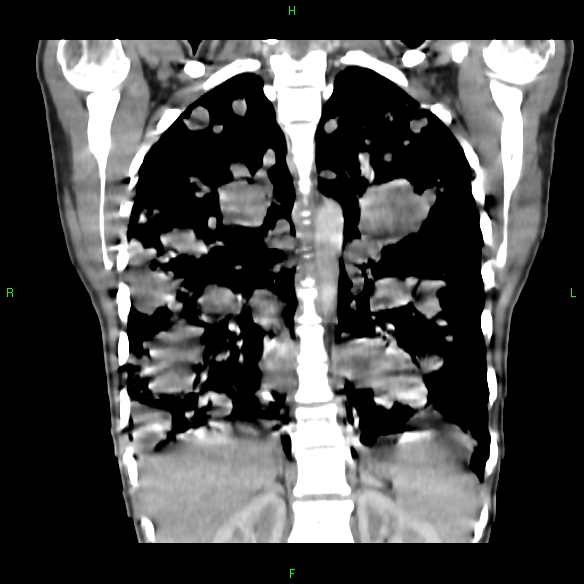 File:Cannon ball metastases - synovial sarcoma (Radiopaedia 26135-26271 Coronal liver window 13).jpg