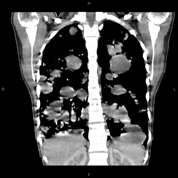 File:Cannon ball metastases - synovial sarcoma (Radiopaedia 26135-26271 Coronal liver window 14).jpg