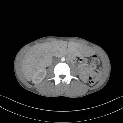Cannonball metastases - testicular choriocarcinoma (Radiopaedia 84510-99891 B 133).jpg