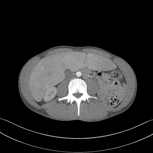 Cannonball metastases - testicular choriocarcinoma (Radiopaedia 84510-99891 B 136).jpg