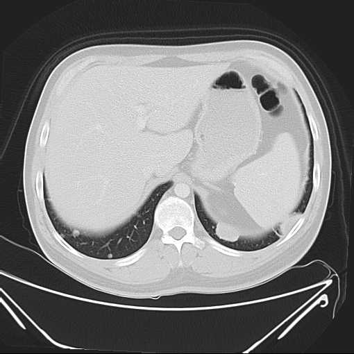 File:Cannonball pulmonary metastases (Radiopaedia 67684-77101 Axial lung window 24).jpg