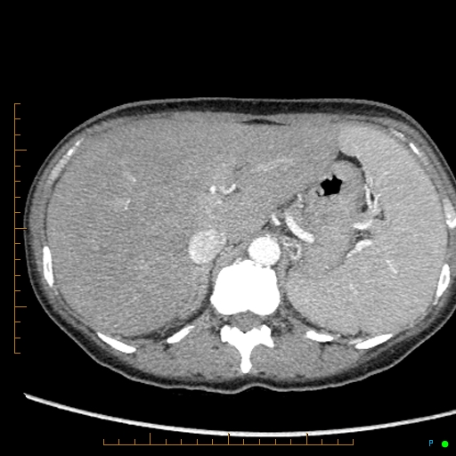 File:Canonball lung metastasis (Radiopaedia 77634-89837 B 103).jpg