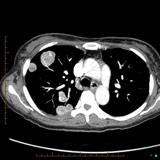 Canonball lung metastasis (Radiopaedia 77634-89837 B 32).jpg