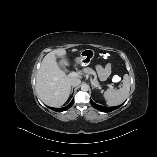 Carcinoid tumor - terminal ileum (Radiopaedia 60931-68739 A 35).jpg