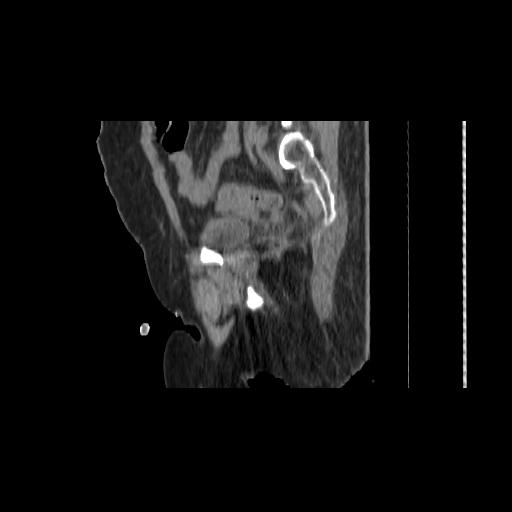 File:Carcinoma cervix- brachytherapy applicator (Radiopaedia 33135-34173 D 128).jpg