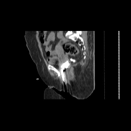 File:Carcinoma cervix- brachytherapy applicator (Radiopaedia 33135-34173 D 72).jpg