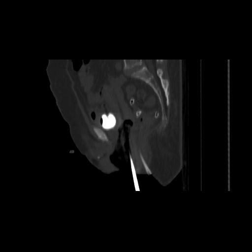 File:Carcinoma cervix- brachytherapy applicator (Radiopaedia 33135-34173 Sagittal bone window 94).jpg