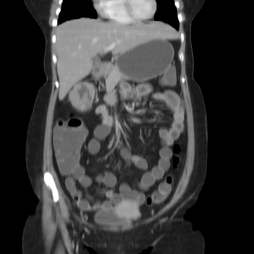 File:Carcinoma colon - hepatic flexure (Radiopaedia 19461-19493 B 13).jpg