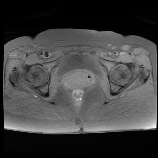 File:Carcinoma of the cervix (Radiopaedia 89018-105858 Axial T1 fat sat 13).jpg