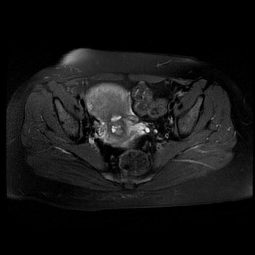 File:Carcinoma of the cervix (Radiopaedia 89018-105858 Axial T2 fat sat 8).jpg