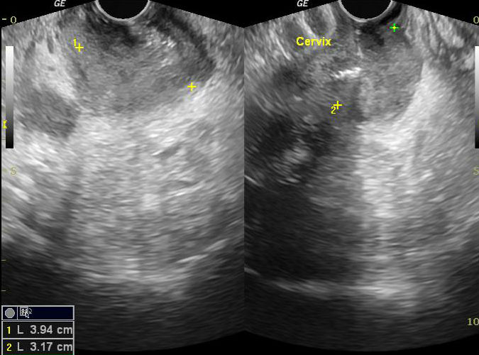 File:Carcinoma of the cervix - squamous cell (Radiopaedia 30432-31097 C 1).jpg