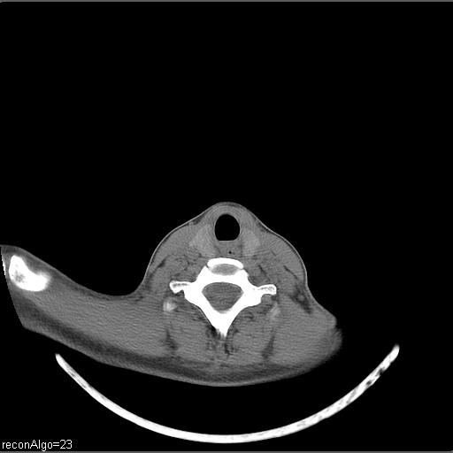 Carcinoma of the maxillary antrum (Radiopaedia 53805-59888 Axial non-contrast 18).jpg