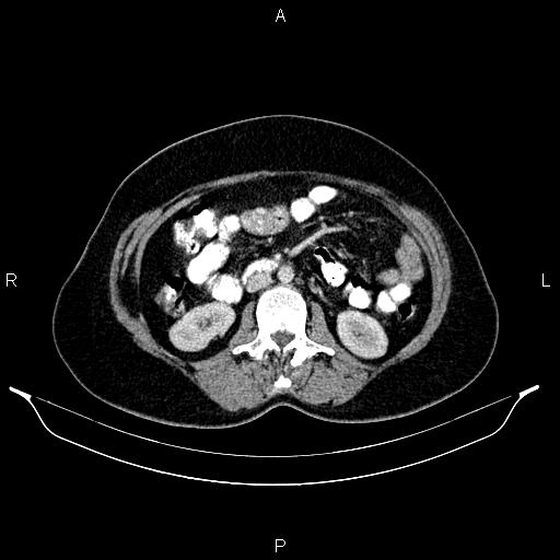Carcinoma of uterine cervix (Radiopaedia 85861-101700 A 47).jpg