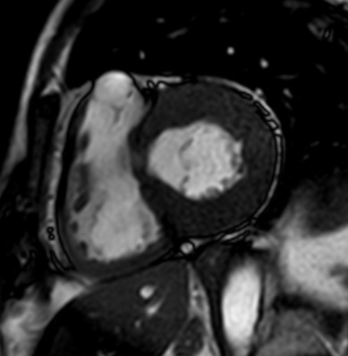 Cardiac amyloidosis - ATTR wild-type (Radiopaedia 74412-85296 short axis cine SSFP 139).jpg