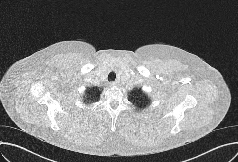 Cardiac sarcoidosis (Radiopaedia 74548-85534 Axial lung window 6).jpg