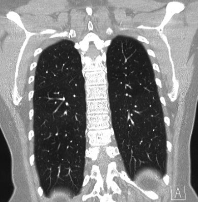 File:Cardiac sarcoidosis (Radiopaedia 74548-85534 Coronal lung window 55).jpg