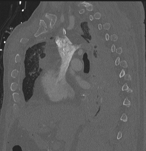 File:Cardiac trauma (Radiopaedia 32874-33858 Sagittal bone window 61).jpg