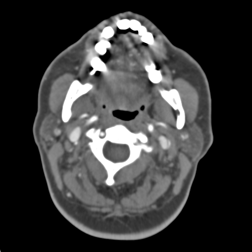 Carotico ophthalmic aneurysm (Radiopaedia 42916-46148 A 57).png