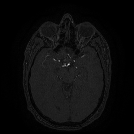 Carotid arterial dissection with acute cerebral infarction (Radiopaedia 26636-26784 MRA 96).jpg