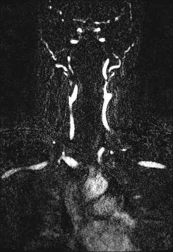Carotid artery dissection (Radiopaedia 28441-28689 Coronal MRA 39).jpg