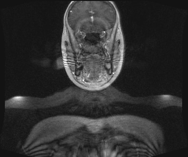 Carotid body tumor (Radiopaedia 12777-12912 MRA 9).jpg