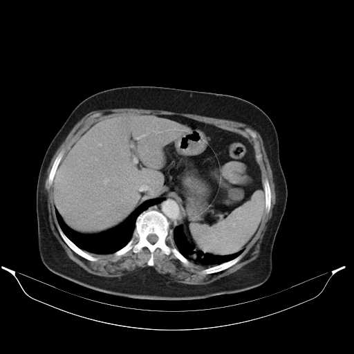 Carotid body tumor (Radiopaedia 21021-20948 A 53).jpg