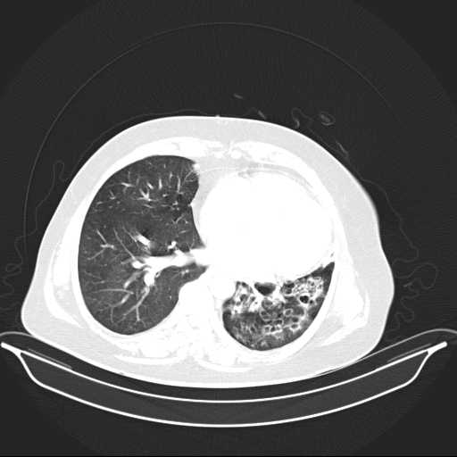 File:Carotid body tumor (Radiopaedia 21021-20948 Axial lung window 27).jpg