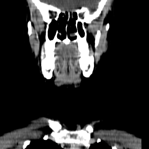 File:Carotid body tumor (Radiopaedia 27890-28124 B 18).jpg