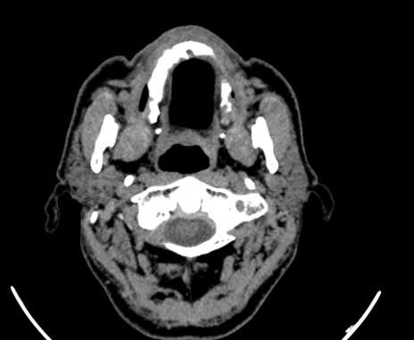 Carotid body tumor (Radiopaedia 61750-69757 Axial non-contrast 12).jpg