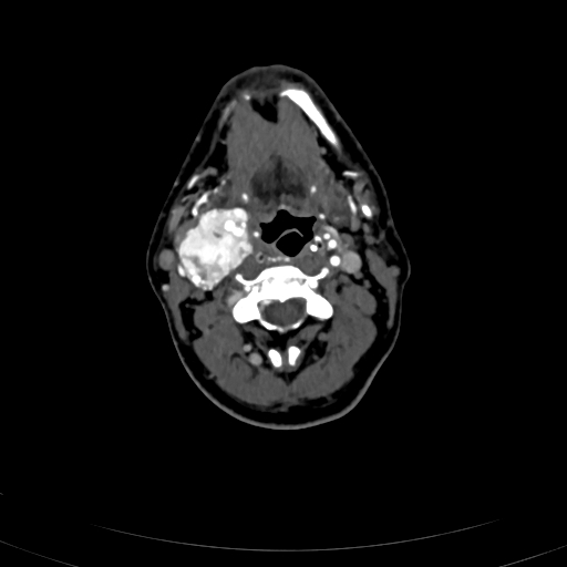 Carotid body tumor (Radiopaedia 83615-98727 A 55).jpg
