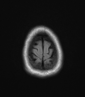 File:Cavernoma with bleed - midbrain (Radiopaedia 54546-60774 Axial FLAIR 29).png