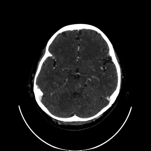 Cavernoma with developmental venous anomaly (Radiopaedia 22470-22506 C 56).jpg