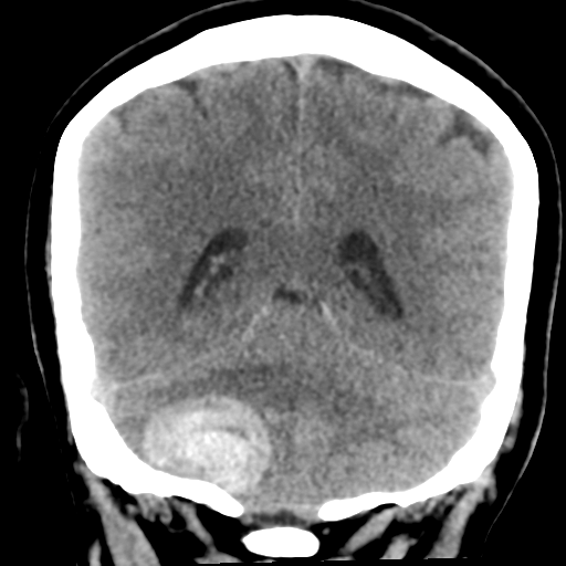 Cavernoma with hemorrhage (Radiopaedia 70755-80931 Coronal non-contrast 43).png