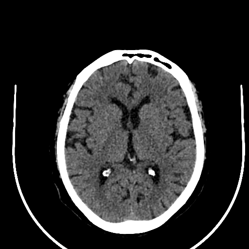 Cavernous hemangioma of the cerebellar falx (Radiopaedia 73025-83723 Axial non-contrast 73).jpg