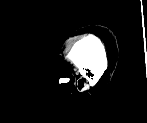 Cavernous hemangioma of the cerebellar falx (Radiopaedia 73025-83723 B 24).jpg