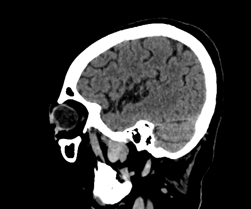 Cavernous hemangioma of the cerebellar falx (Radiopaedia 73025-83723 B 253).jpg