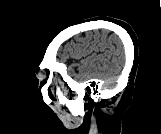 Cavernous hemangioma of the cerebellar falx (Radiopaedia 73025-83723 B 270).jpg