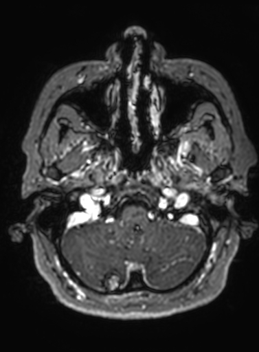 Cavernous hemangioma of the cerebellar falx (Radiopaedia 73025-83724 Axial T1 C+ 291).jpg