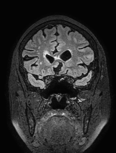 Cavernous hemangioma of the cerebellar falx (Radiopaedia 73025-83724 Coronal FLAIR 105).jpg