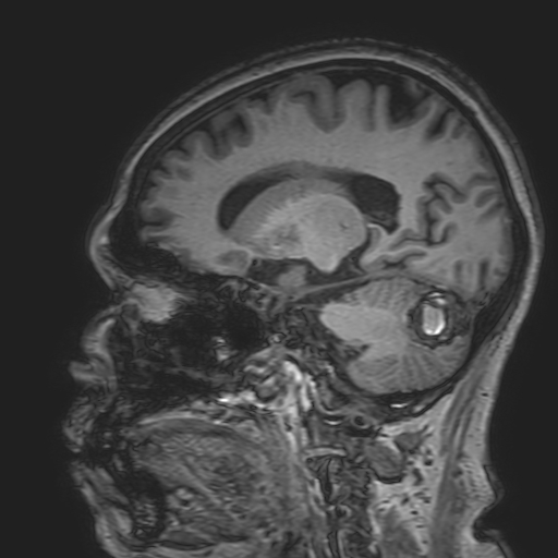 File:Cavernous hemangioma of the cerebellar falx (Radiopaedia 73025-83724 Sagittal T1 84).jpg