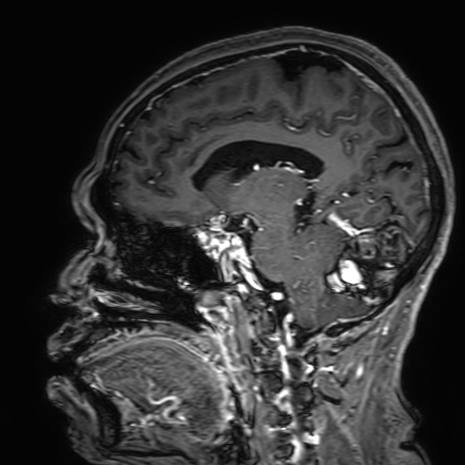 File:Cavernous hemangioma of the cerebellar falx (Radiopaedia 73025-83724 Sagittal T1 C+ 121).jpg